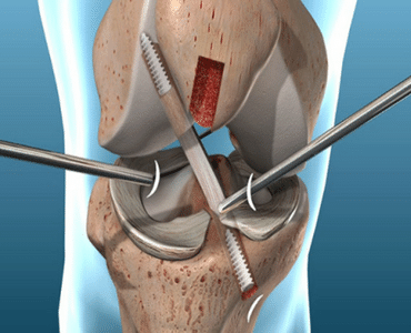 Corrección quirúrgica de ruptura de Ligamento cruzado anterior y meniscos